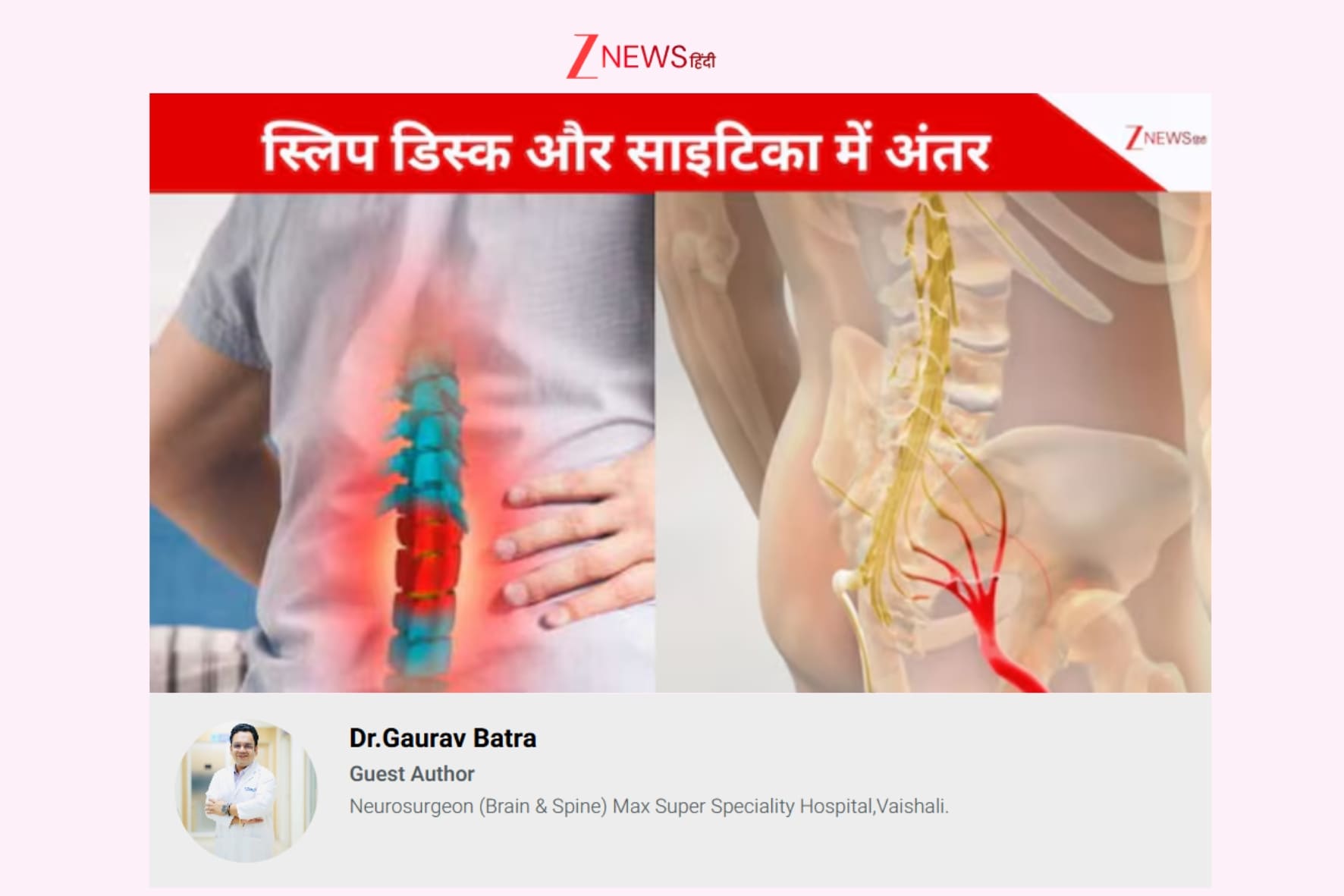 Dr. Gaurav Batra Neurosurgeon Media Coverage ZNEWS Hindi | Best Neurosurgeon For Brain and Spine in Delhi NCR